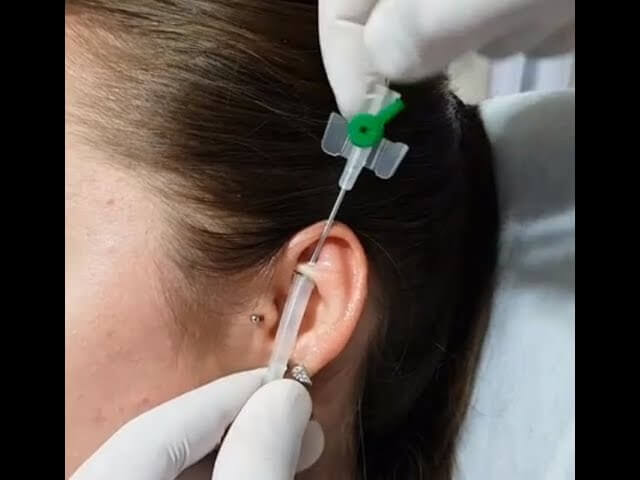 intraket piercing
